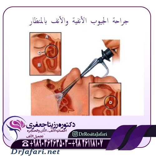 جراحة الجيوب الأنفية والأنف بالمنظار