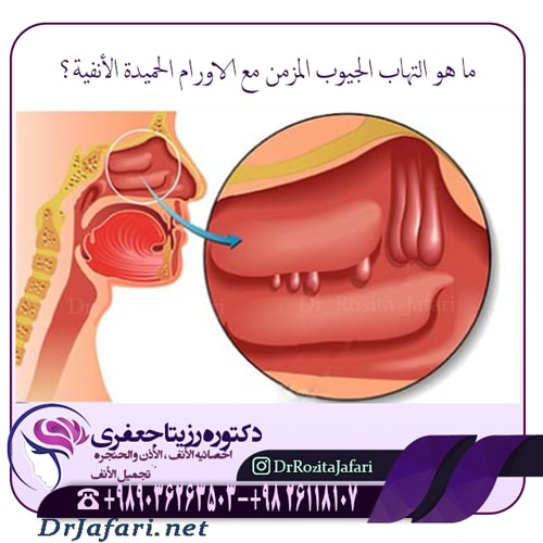 ما هو التهاب الجيوب المزمن مع الاورام الحميدة الأنفية؟