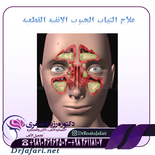 علاج التهاب الجیوب الانفیه القطعیه