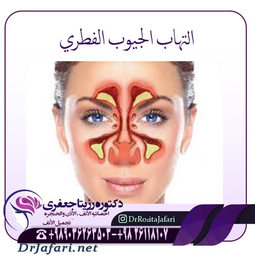 التهاب الجيوب الفطري             