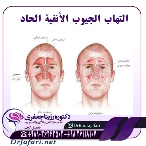 التهاب الجيوب الأنفية الحاد