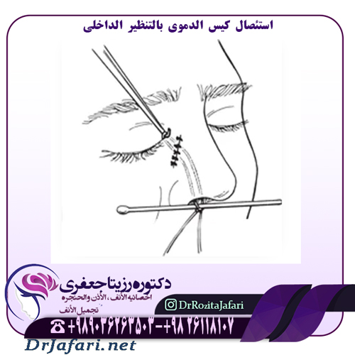 استئصال كيس الدموي بالتنظير الداخلي باستخدام السديلة المخاطية للتداخل الثنائي