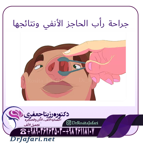 جراحة رأب الحاجز الأنفي ونتائجها